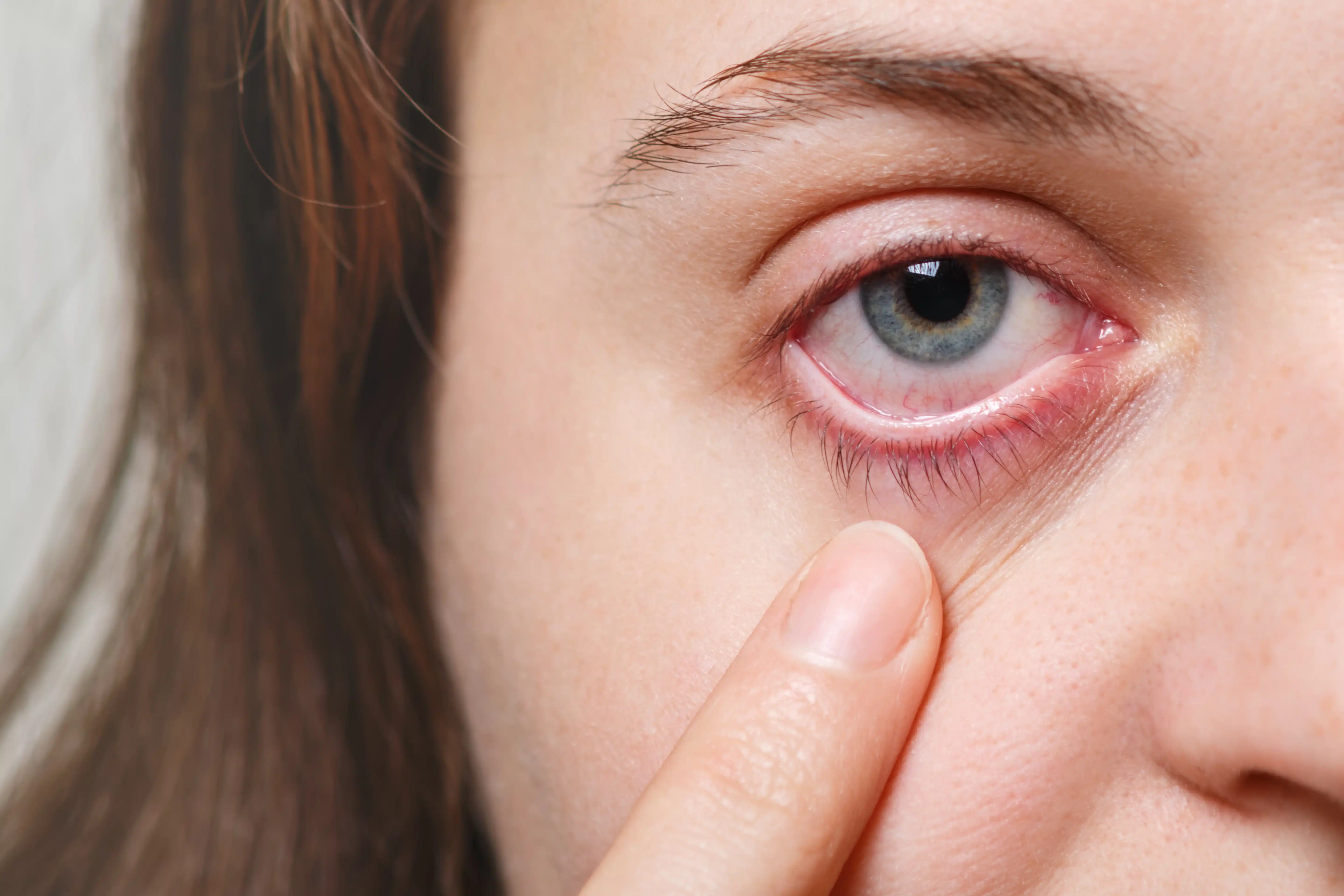 pink eye infection