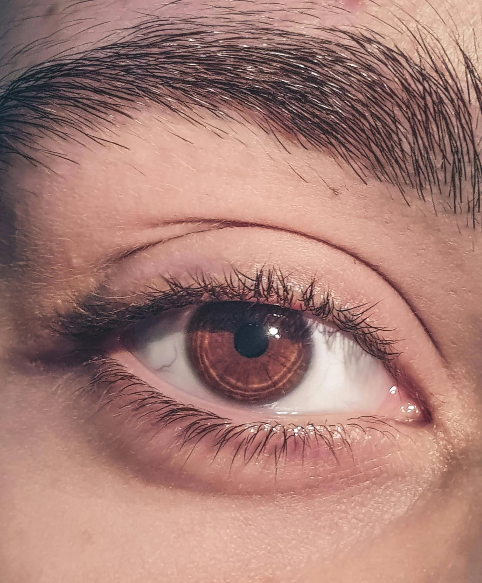 eye floaters symptoms